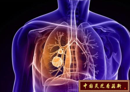 菇新提示：肺癌应尽早发现 治疗