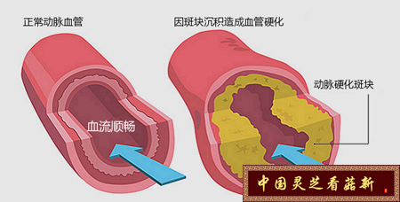 灵芝孢子粉可降血脂